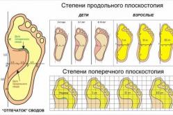 Foot massage - acupressure, with flat feet, with valgus foot, for a child Foot massager for flat feet for children