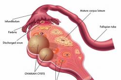 Inflammation of the ovarian cyst symptoms