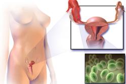 Mechanism of ovarian apoplexy when surgery is required
