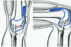 Damage to the meniscus of the knee joint